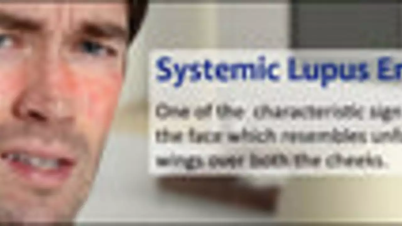 The Relationship Between Discoid and Systemic Lupus Erythematosus and Blood Disorders