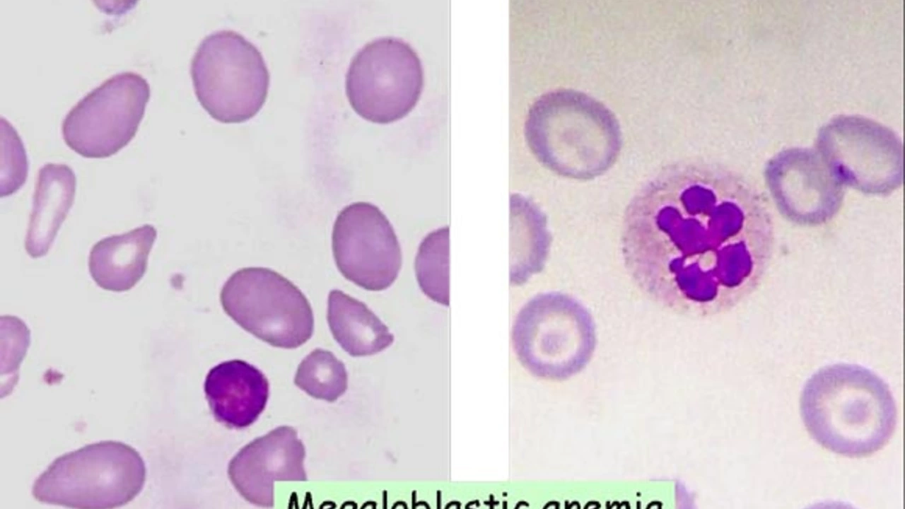 The Connection between Folic Acid Deficiency and Megaloblastic Anemia in Cancer Patients